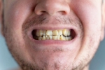 Nicotine stains bad, Nicotine stains, are nicotine stains on your teeth irreversible, Tooth enamel