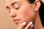 skin care products, acne, 10 ways to get rid of pimples at home, Unsc