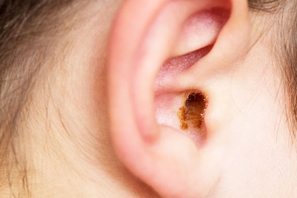 How to Remove Ear Wax?