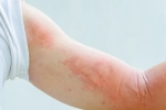 covid-19, covid-19, dermatological symptoms could be a sign for covid 19 infection, Dermatologist