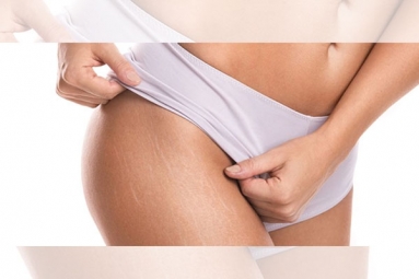 Difference between Red and White Stretch Marks Explained and It’s Natural to Have Them