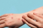 Monkeypox news, Monkeypox breaking news, study says that the symptoms of monkeypox are different from earlier, Monkeypox